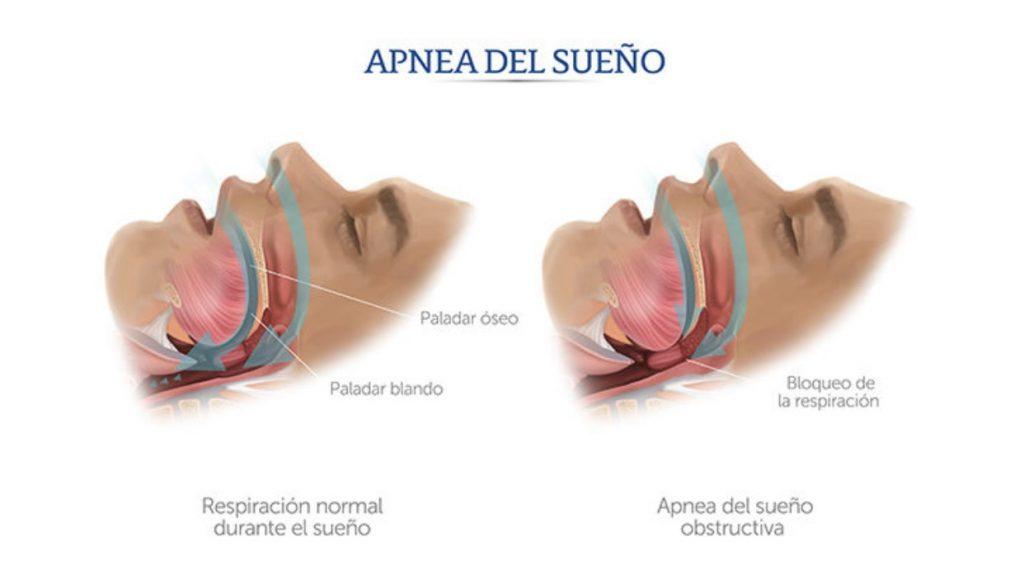 Aparatos orales para la apnea del sueño - Clínica Trei