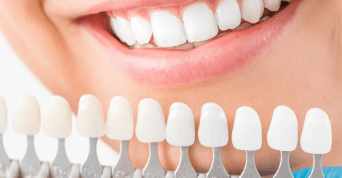 blanqueamiento dental combinado