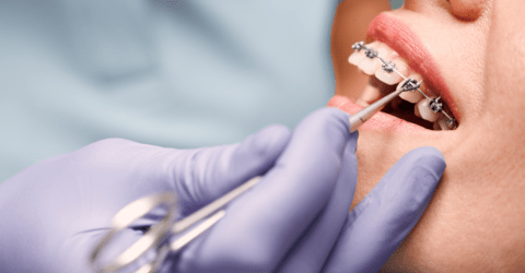Ortodoncia con Brackets