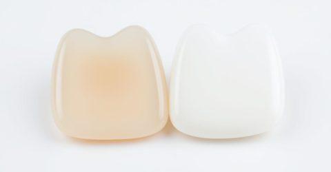 Carillas de composite o porcelana